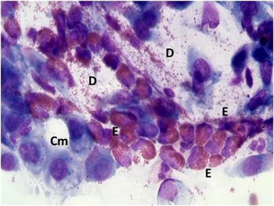 Nasal Cytology: A Easy Diagnostic Tool in Precision Medicine for Inflammation in Epithelial Barrier Damage in the Nose. A Perspective Mini Review